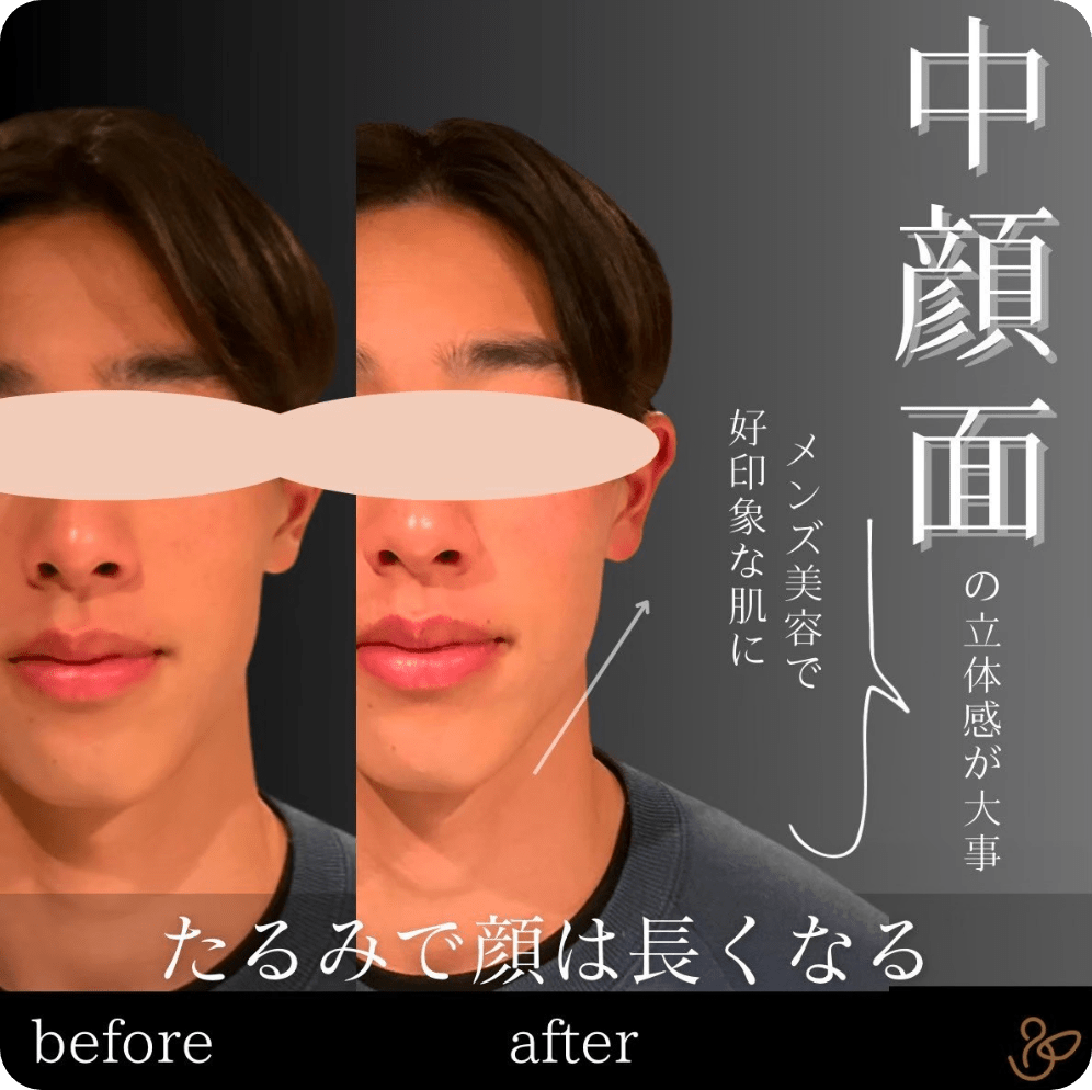 施術前後を比較した写真：中顔面の立体感が大事