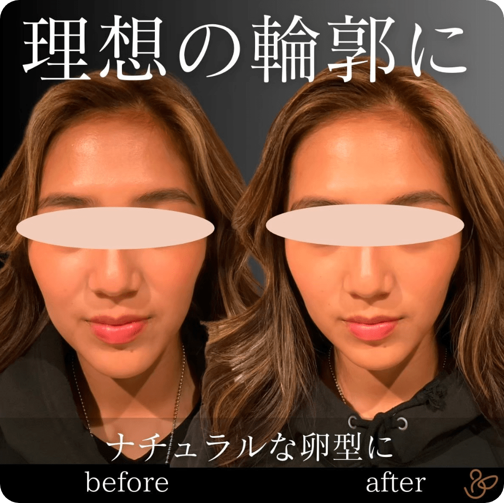 施術前後を比較した写真：理想のナチュラルな卵型の輪郭に