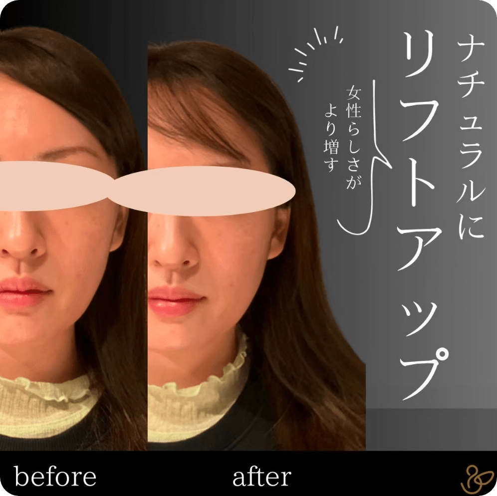 施術前後を比較した写真：ナチュラルにリフトアップ