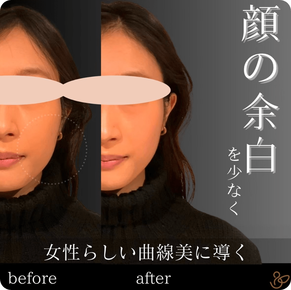 施術前後を比較した写真：顔の余白を少なく女性らしい曲線美に導く