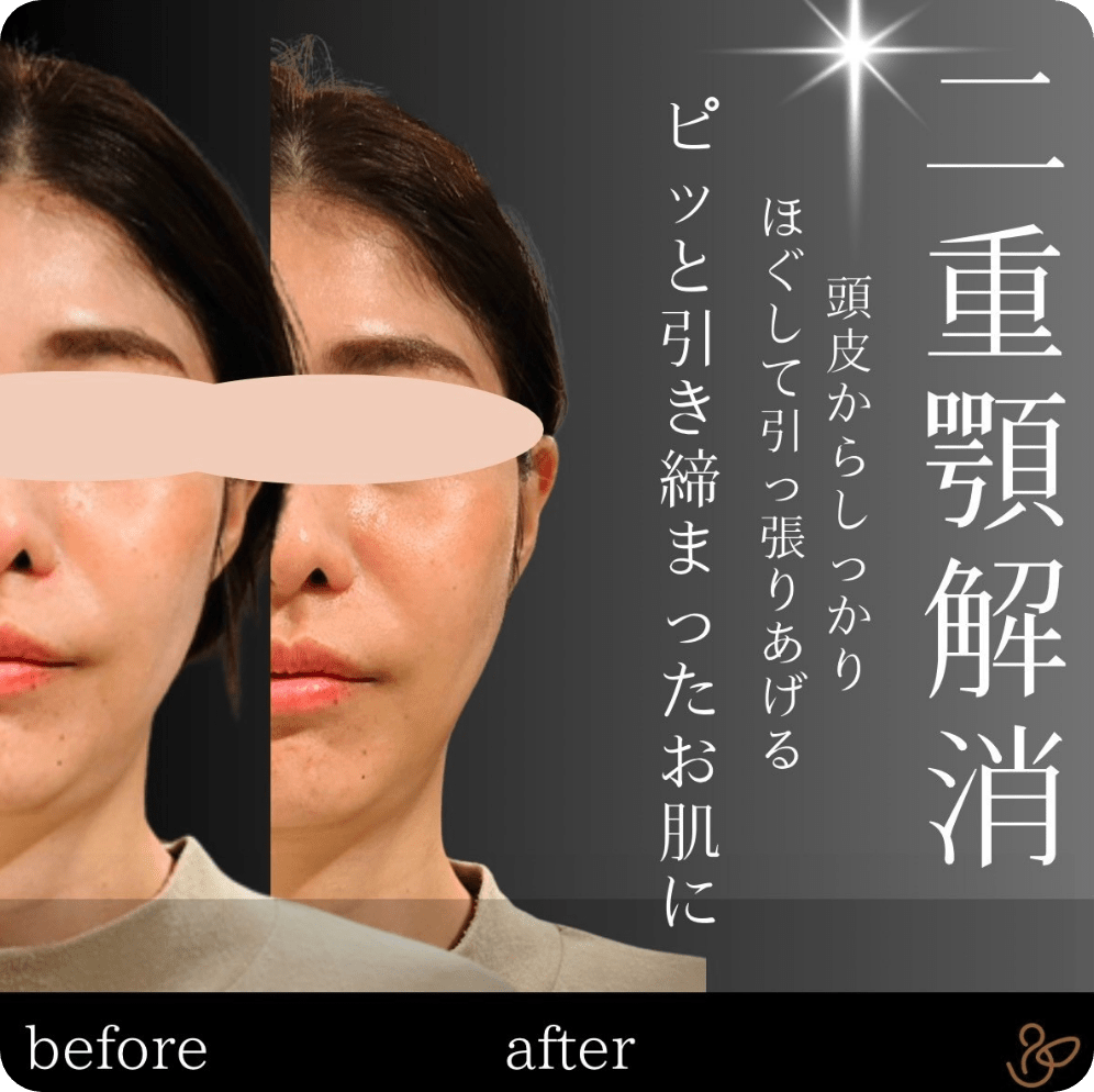 施術前後を比較した写真：二重顎解消