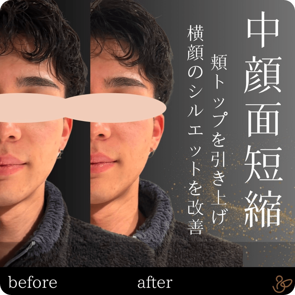 施術前後を比較した写真：中顔面短縮