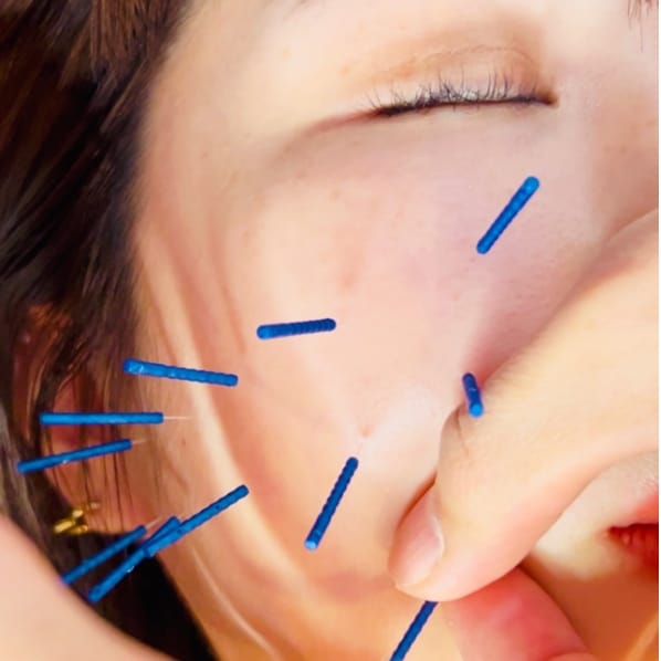 顔に鍼を打ち高い技術で施術を行う様子