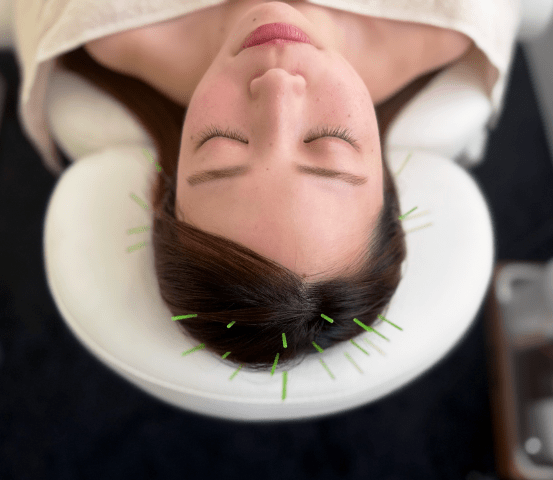 育毛鍼の施術中の様子