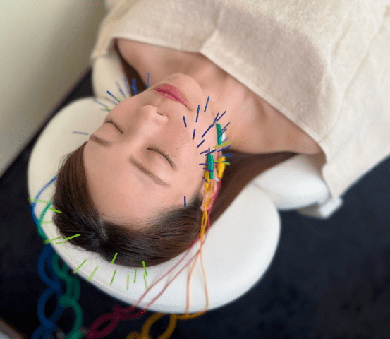 チョコバリWの施術中の様子