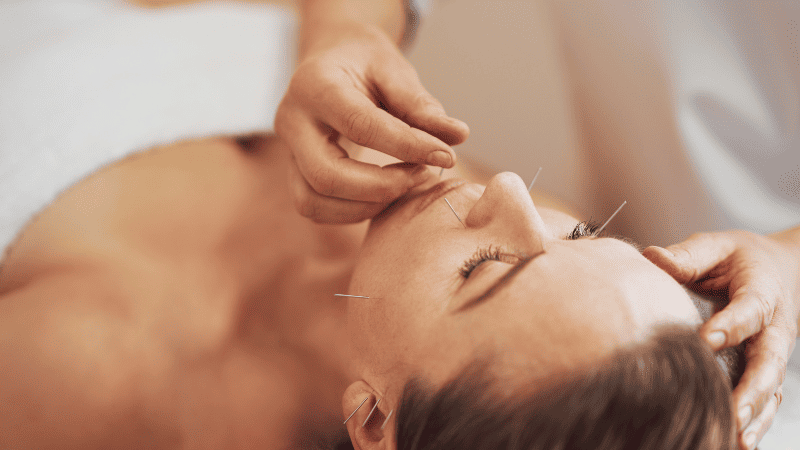 美容鍼を受けている女性