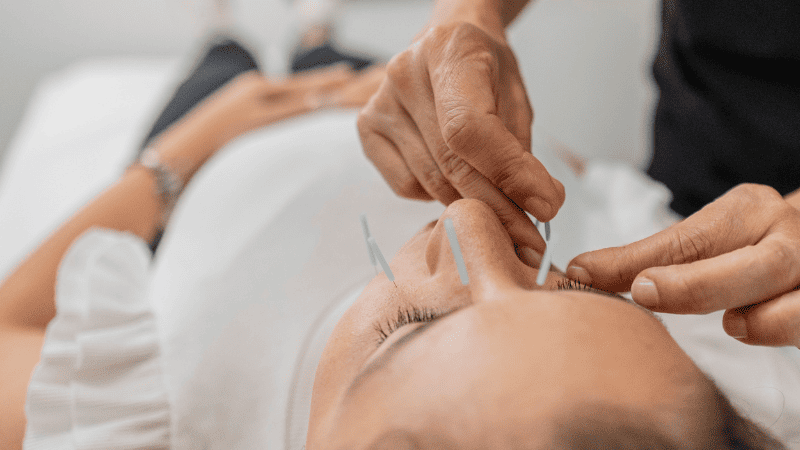 美容鍼の施術をされている女性