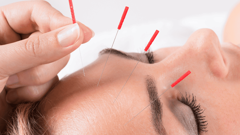 美容鍼の施術をされている女性