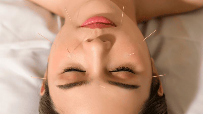美容鍼を受けている女性