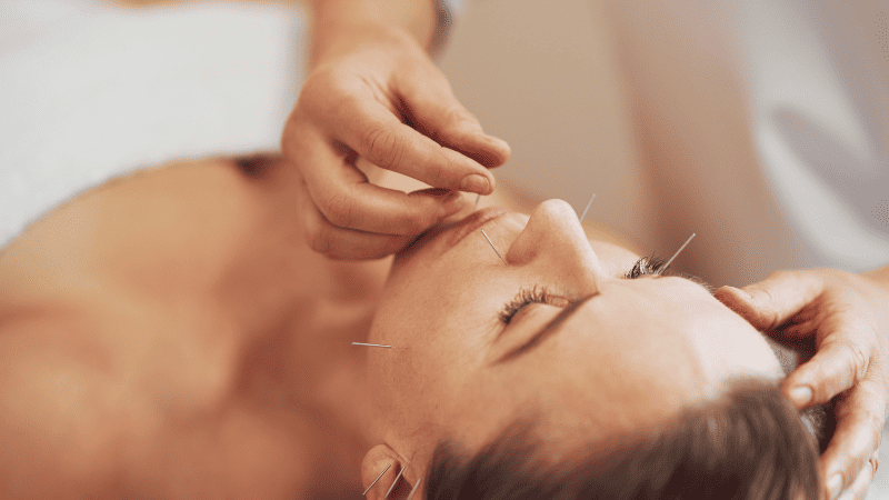 美容鍼を受けている女性