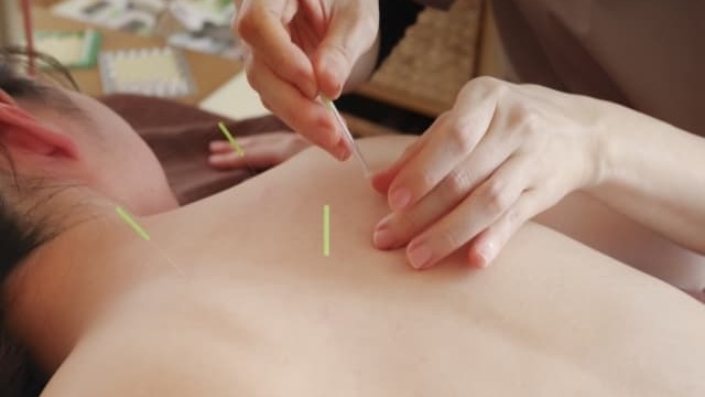女性が肩に鍼治療を受けている様子