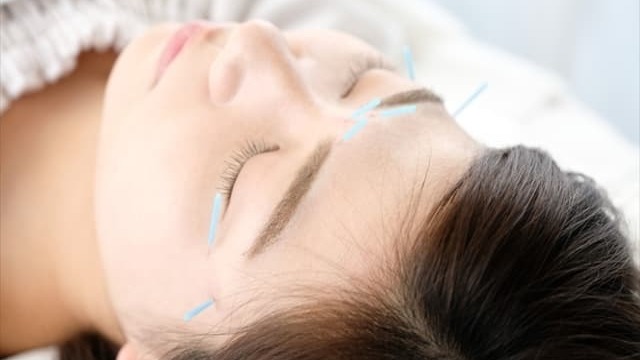女性が顔に鍼治療を受けている様子
