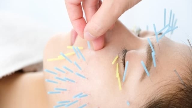 女性が顔に鍼を受けている様子