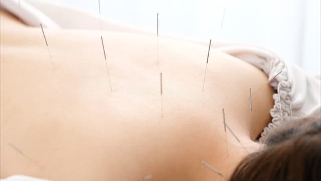 女性が背中に鍼治療を受けている様子