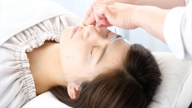 女性が顔に鍼を受けている様子