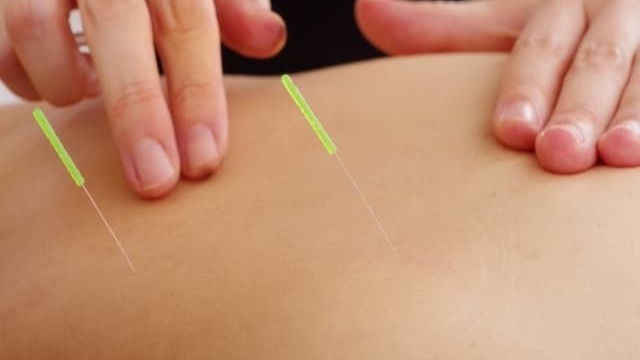 鍼治療を受けている様子