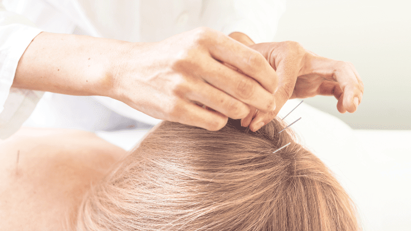 頭皮に鍼灸施術をしている様子