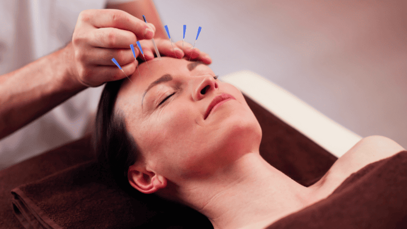 育毛鍼の施術を受けている女性