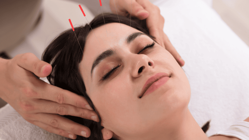 育毛鍼の施術を受けている女性