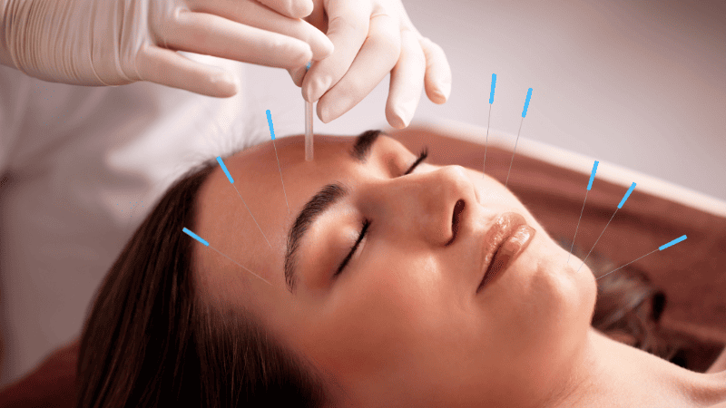 顔に鍼灸の施術を受けている女性